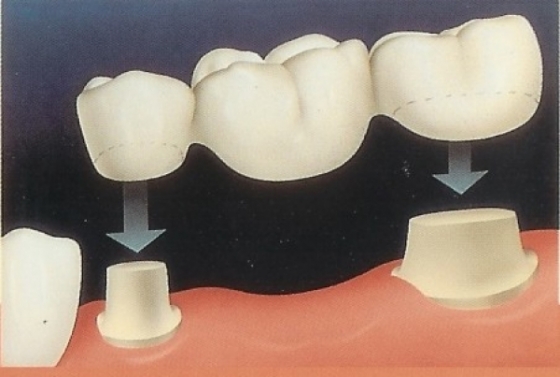 Ce trebuie sa stim despre puntile dentare